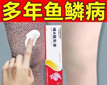 鱼鳞病如何治疗？推荐使用哪种药物？