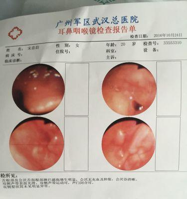 喉镜检查费用是多少？鱼刺卡喉的紧急处理方法？