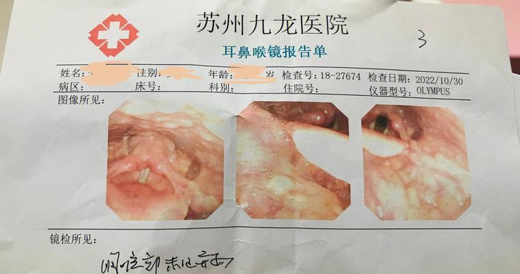 感觉鱼刺卡在食道但是喉镜找不到怎么办？还有其他检查方法吗？