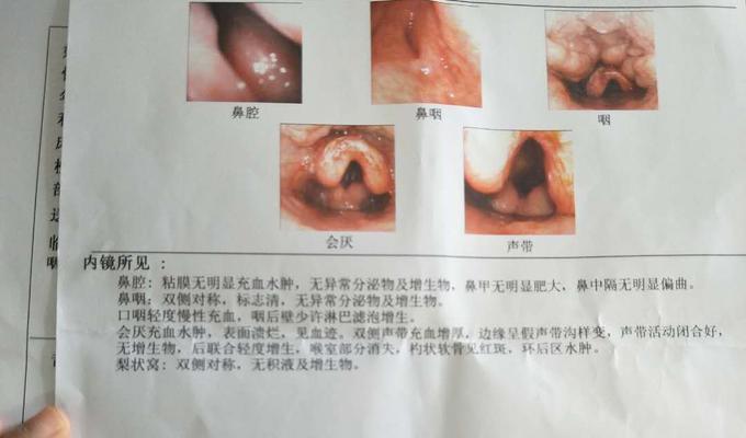 喉镜检查能发现食道中的鱼刺吗？